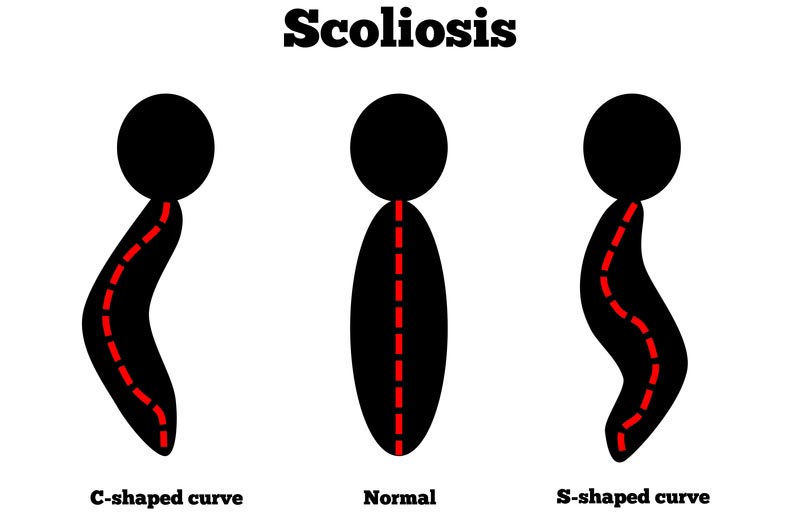 Van Nuys, CA scoliosis treatment